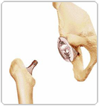 Hip replacement surgery in mumbai